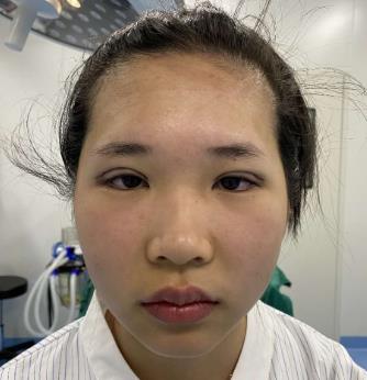 宁波尚丽姜艳医生双眼皮真实案例分享,我也拥有漂亮的双眼皮了