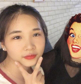 宁波尚丽姜艳医生双眼皮真实案例分享,我也拥有漂亮的双眼皮了