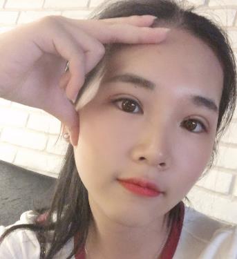 宁波尚丽姜艳医生双眼皮真实案例分享,我也拥有漂亮的双眼皮了
