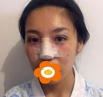 上海九院自体软骨隆鼻+双眼皮经验分享，果对比照片