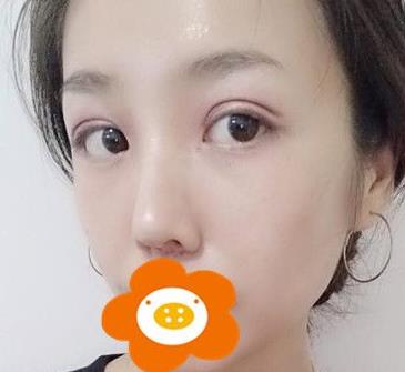 上海九院自体软骨隆鼻+双眼皮经验分享，果对比照片