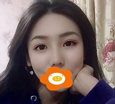 上海九院自体软骨隆鼻+双眼皮经验分享，果对比照片