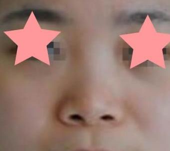 株洲中心医院整形科鼻部手术案例反馈：两个月后果真不赖！
