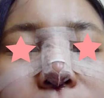 株洲中心医院整形科鼻部手术案例反馈：两个月后果真不赖！