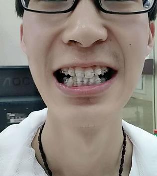 南京口腔医院美容科整牙怎么样？牙齿矫正案例对比图