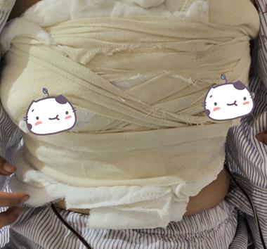北京八大处隆胸怎么样？自体脂肪隆胸真人案例！