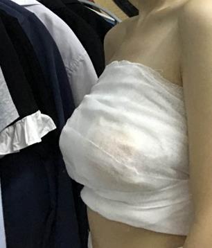 北京八大处隆胸怎么样？自体脂肪隆胸真人案例！