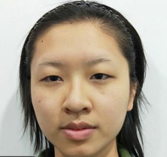 常州第二人民医院美容整形科双眼皮果怎么样?分享真实双眼皮恢复过程