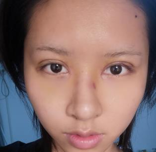 常州第二人民医院美容整形科双眼皮果怎么样?分享真实双眼皮恢复过程