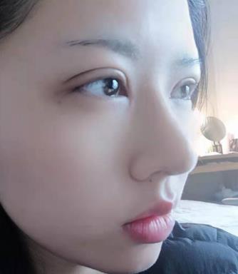 常州第二人民医院美容整形科双眼皮果怎么样?分享真实双眼皮恢复过程