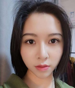 常州第二人民医院美容整形科双眼皮果怎么样?分享真实双眼皮恢复过程