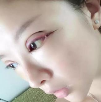 东莞市人民医院整形科割双眼皮技术怎么样?附案例一览