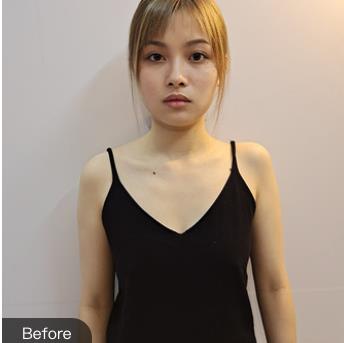 北京八大处隆胸怎么样?王春虎隆胸案例反馈