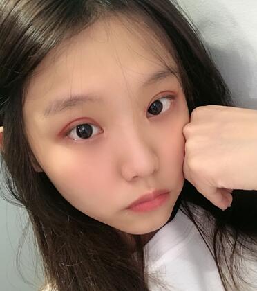 宜宾市第一人民医院整形美容外科双眼皮好不好?案例果图分享