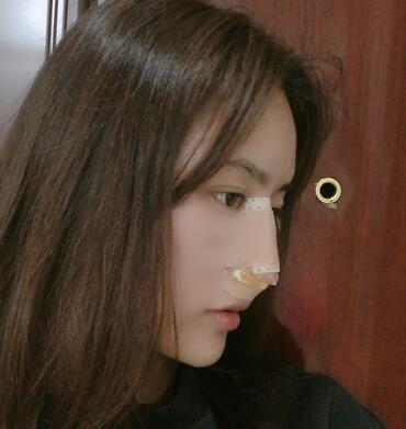 榆林市第二医院整形美容外科隆鼻案例展示,恢复记录给你看