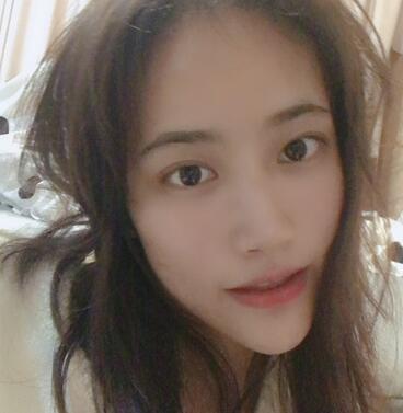 榆林市第二医院整形美容外科隆鼻案例展示,恢复记录给你看