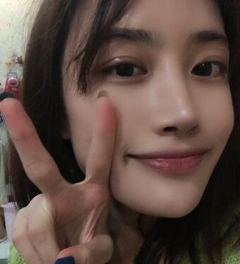 榆林市第二医院整形美容外科隆鼻案例展示,恢复记录给你看