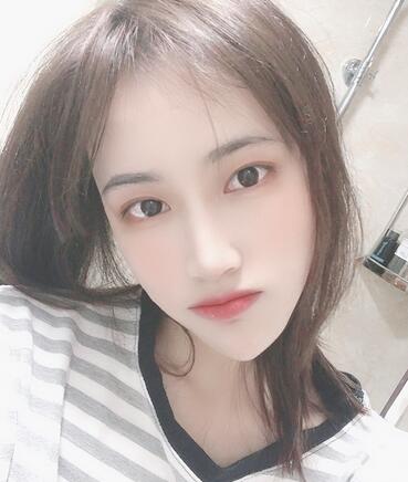 榆林市第二医院整形美容外科隆鼻案例展示,恢复记录给你看