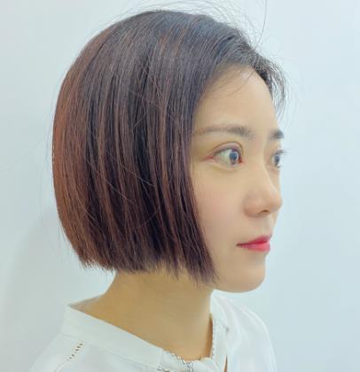 深圳阳光医院双眼皮真人案例恢复过程经验分享