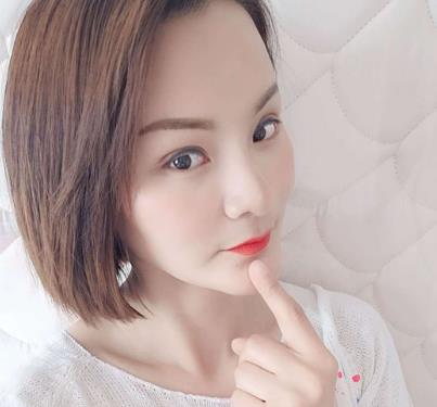 郑州人民医院整形科王剑医生双眼皮修复案例，真实双眼皮修复经验