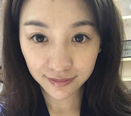成都二医院整形科激光祛斑怎么样？真人案例果图参考