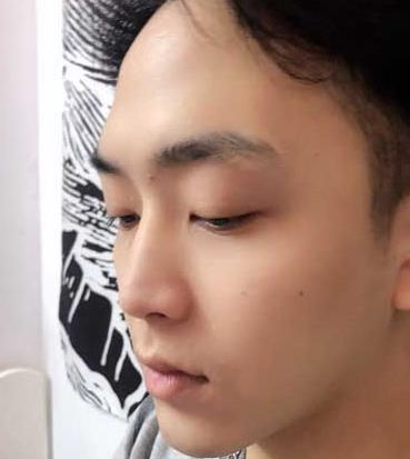 杭州浙二医院整形科隆鼻怎么样？真实隆鼻4个月果