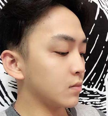 杭州浙二医院整形科隆鼻怎么样？真实隆鼻4个月果