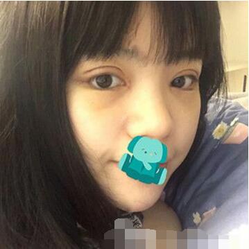 上海九院曹卫刚双眼皮案例反馈，全切双眼皮恢复过程