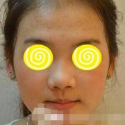 反馈：北京八大处靳小雷的一个隆鼻修复术的三个月果