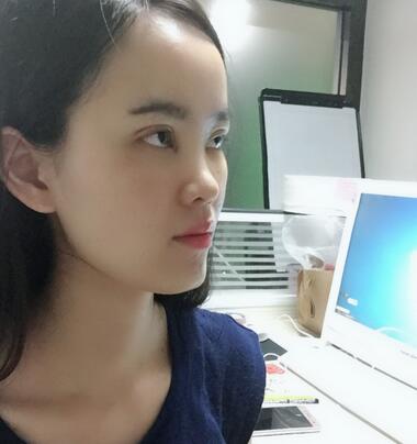 湖南省第二人民医院整形美容科隆鼻术后多角度图片分享，超自然