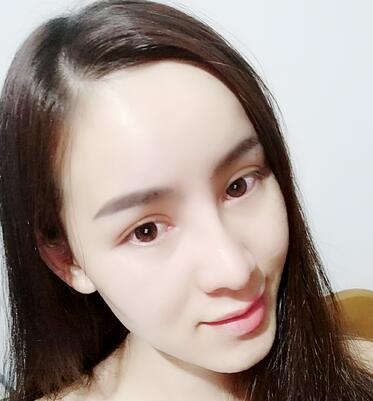 湖南省第二人民医院整形美容科隆鼻术后多角度图片分享，超自然