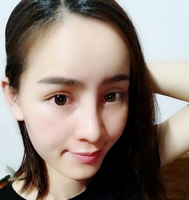 湖南省第二人民医院整形美容科隆鼻术后多角度图片分享，超自然