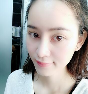 湖南省第二人民医院整形美容科隆鼻术后多角度图片分享，超自然