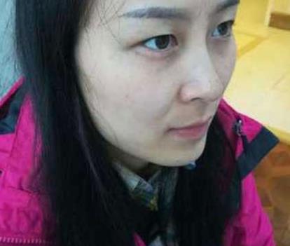长沙安吉娜整形医院做双眼皮案例！分享做双眼皮的心理感受！