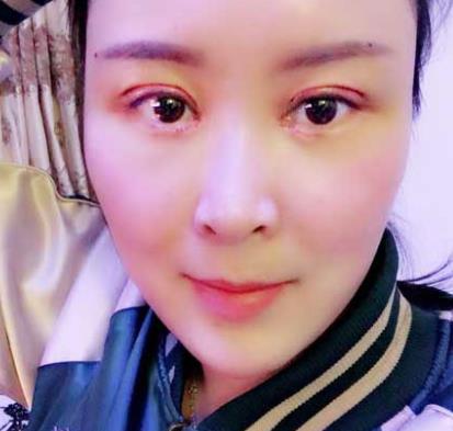 长沙安吉娜整形医院做双眼皮案例！分享做双眼皮的心理感受！