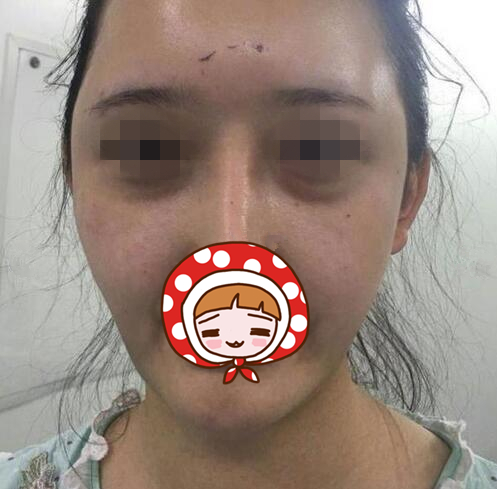 烟台鹏爱整形医院祛眼袋+自体脂肪填充案例，减龄一步到位