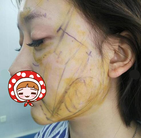 烟台鹏爱整形医院祛眼袋+自体脂肪填充案例，减龄一步到位