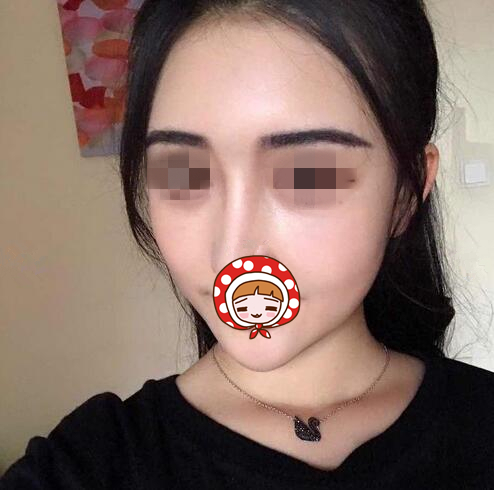 烟台鹏爱整形医院祛眼袋+自体脂肪填充案例，减龄一步到位