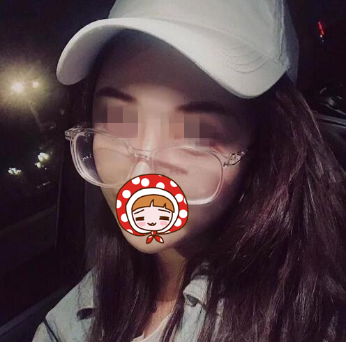 烟台鹏爱整形医院祛眼袋+自体脂肪填充案例，减龄一步到位