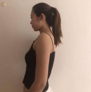 北京美莱整形隆胸怎么样？瞧北京隆胸的一个真实案例分享
