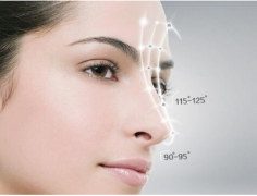 美鼻立显|珠海科美整形医院做鼻翼缩小术,真实案例反馈