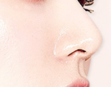 沈阳红叶整形医院鼻翼缩小价格贵吗?多久才能恢复