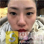 重庆珂琳雅整形价格表，附面部填充案例