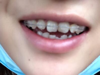 福州贝臣口腔门诊部口碑怎么样？相关案例和价格