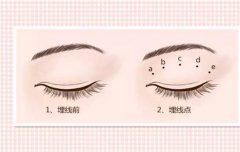 埋线双眼皮果怎么样？原理、价格和优缺点是什么？