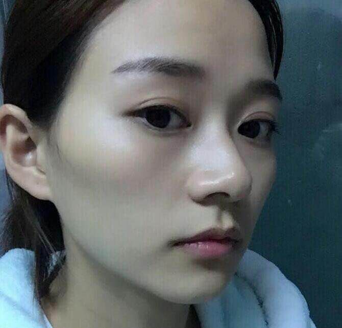 别人忧愁不好割的下颌角,我却使劲浑身解数才想办法把这个给去掉