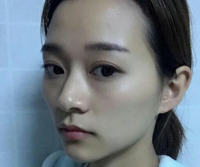 别人忧愁不好割的下颌角,我却使劲浑身解数才想办法把这个给去掉