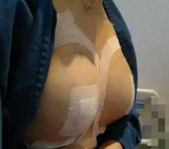 去泰安整形花了5w做隆胸,一个月后姐妹们看完我做的亏不亏