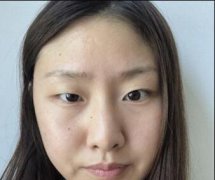 合肥105整形花8000做的双眼皮，直接让闺蜜找到男朋友