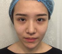 多亏伊尔美整形的眼修复专家，让我摆脱了手术失败这个大阴影